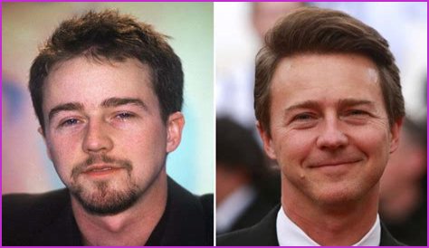 Edward Norton Plastic Surgery Before and After